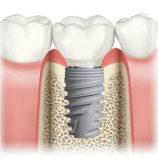 Dental Implant Houston