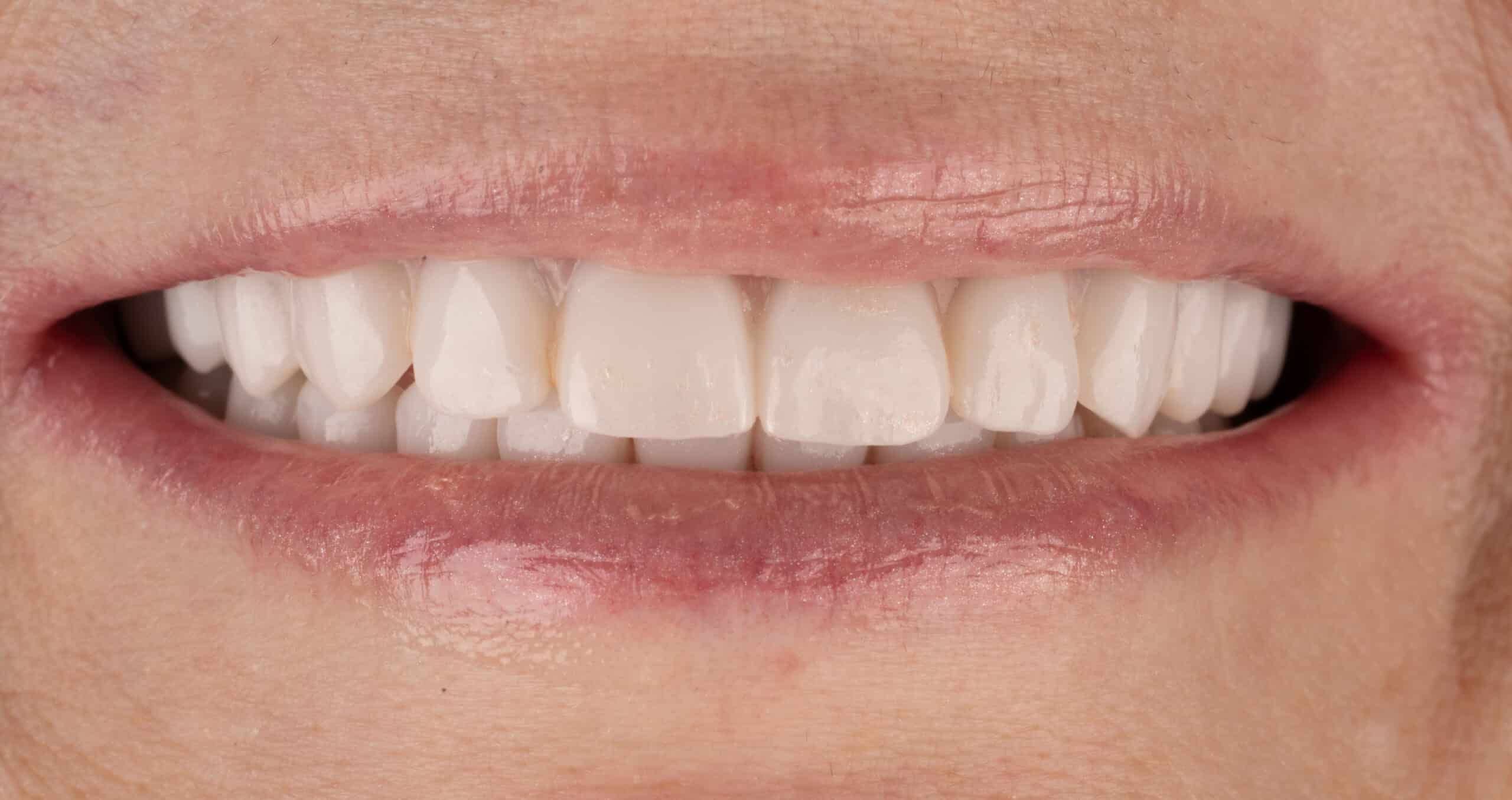 full-mouth-dental-implants
