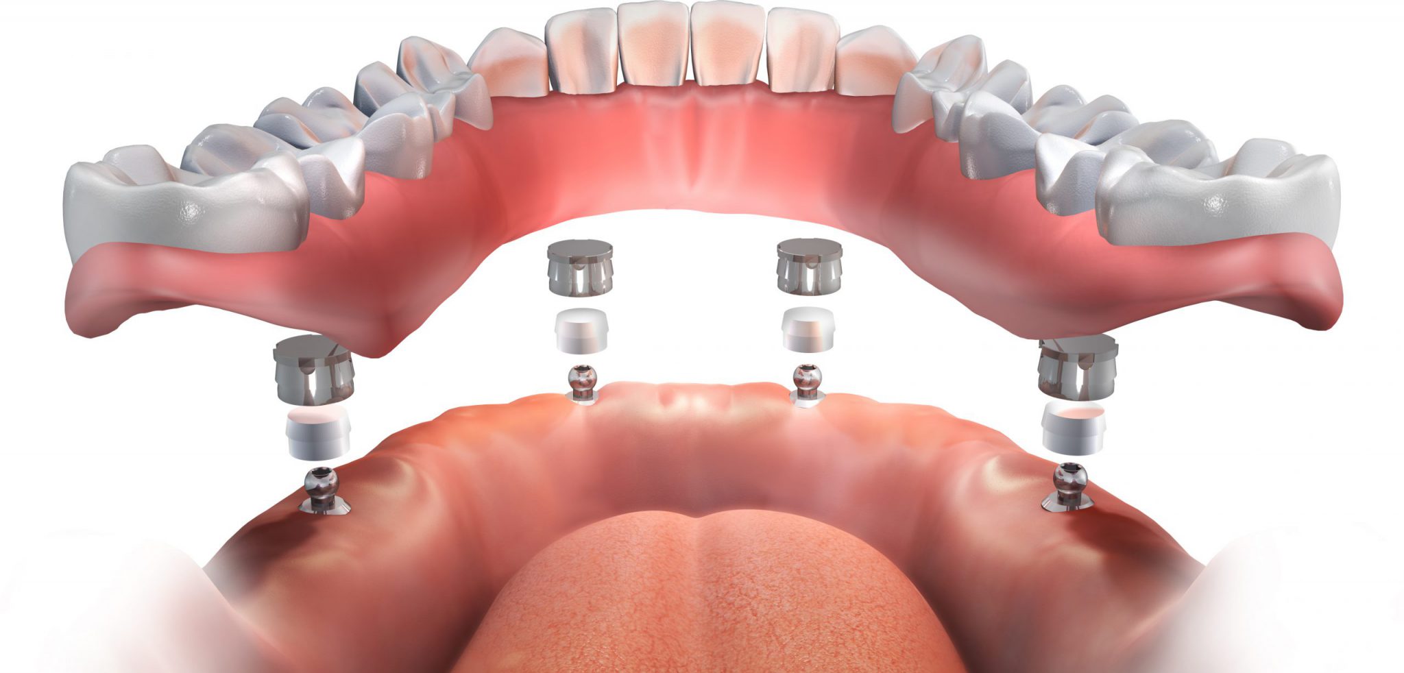 implant-supported-dentures-scaled-e1602273071293-2048x982