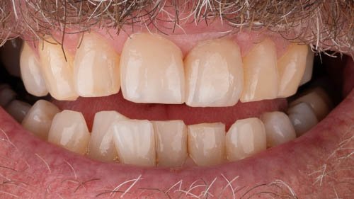 Front teeth restored with porcelain veneers after trauma from a fall
