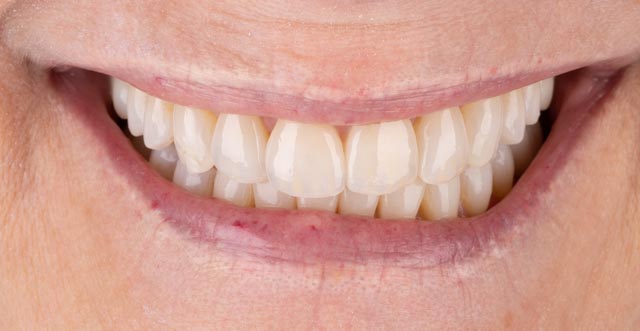 Porcelain Veneer results at Houston Dental Implants and Prosthodontics