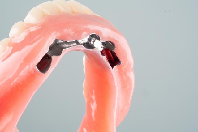Implant dentures in Houston - snap-in and fixed options