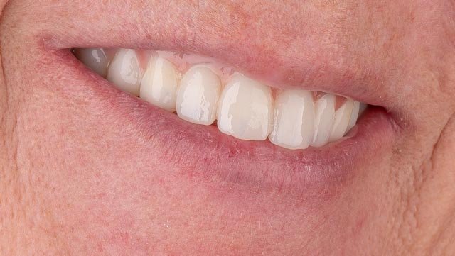Patient smile after full mouth dental implants treatment in Houston