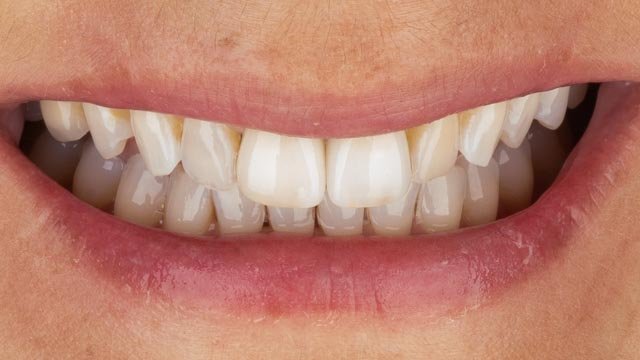 Final smile with implant crown on tooth #8 and natural-tooth crown on #9