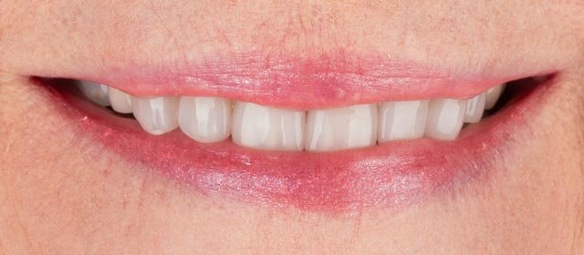A close-up of a confident smile showcasing healthy, restored teeth achieved through Houston prosthodontics expertise.