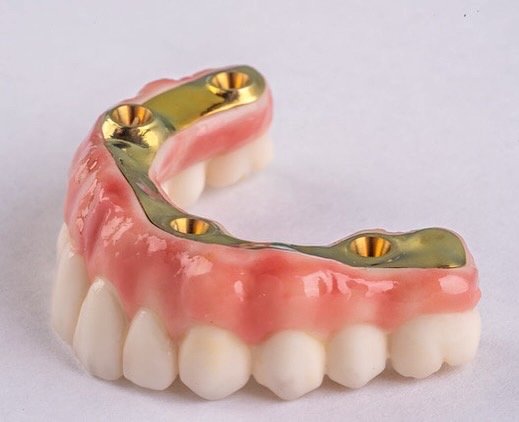 All-On-4 Ceramic Implant Denture