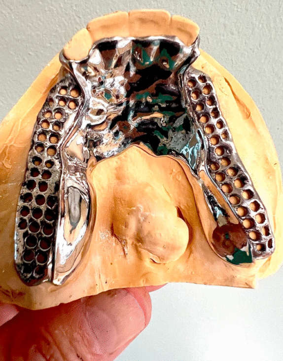 Precisely Fitting Removable Partial Denture Framework digitally designed and fabricated by Dr. Mark Stankewitz, Prosthodontist.