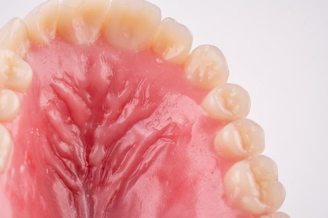 Implant Denture Dr. Stankewitz