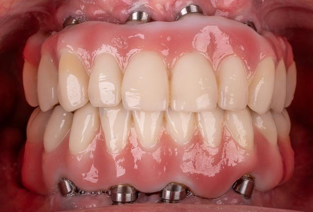 fixed-implant-dentures-houston-upper-lower