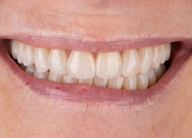 After porcelain veneer treatment replacing old resin veneers with a brighter, natural-looking smile