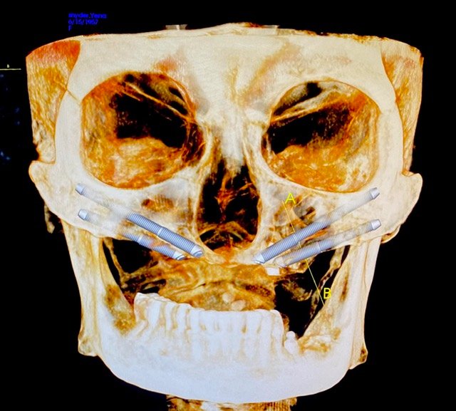 Four zygomatic implants supporting a full-arch restoration