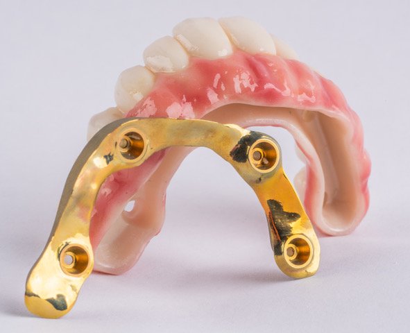 Custom full-arch implant prosthesis designed by Dr. Mark Stankewitz