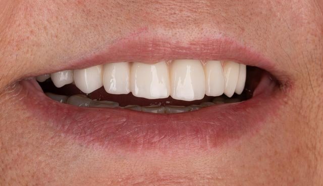 Final smile after complex full-arch implant restoration