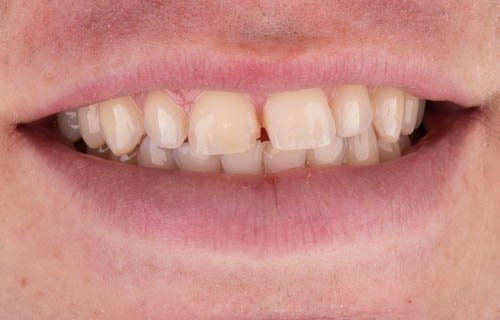 Gap Between the Two Front Teeth