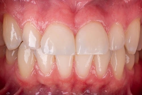 Two upper front teeth restored with porcelain veneers after treatment