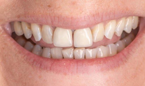 Before replacement of upper front tooth #8 with a dental implant